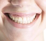 Amalgam-Zahnfüllungen mit Quecksilber